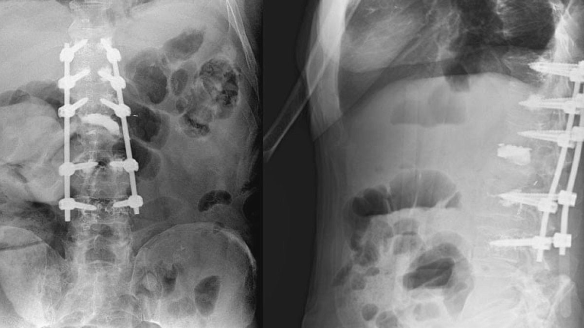 Ağrı şikayetiyle hastaneye geldi, 8,5 kilogramlık tümörlü böbrek çıktı