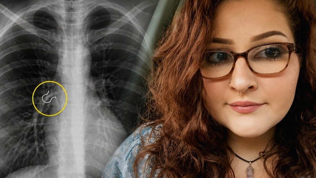Genç Kadının Öksürük Nöbetlerinin Gizemi Çözüldü: Akciğerinden Metal Parça Çıktı