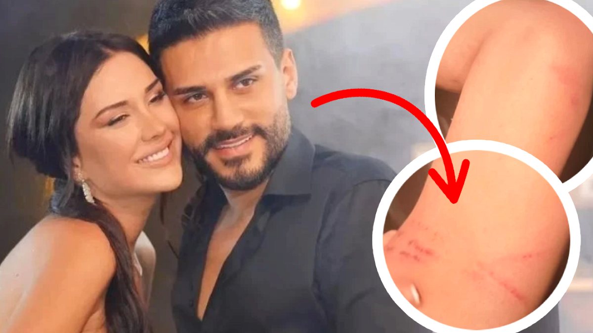 Dilan Polat'tan Şok Paylaşım: Darp İzleri ve Boşanma İlanı