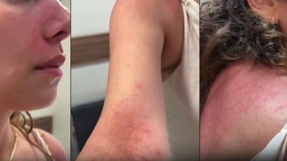 Bali'de ATV Turu Kabusa Döndü: Türk Turist Alerjiyle Savaş Verdi