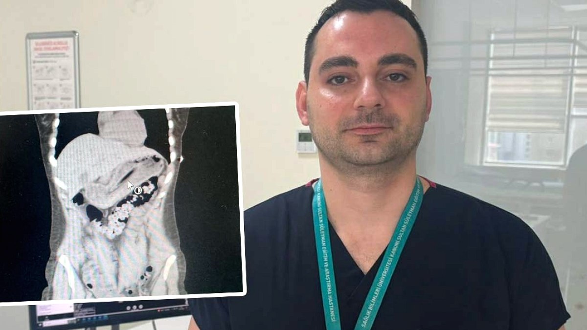 Kilo Verme Uğruna Diş Fırçası Yuttu: Doktorlar Bile Şaşkına Döndü