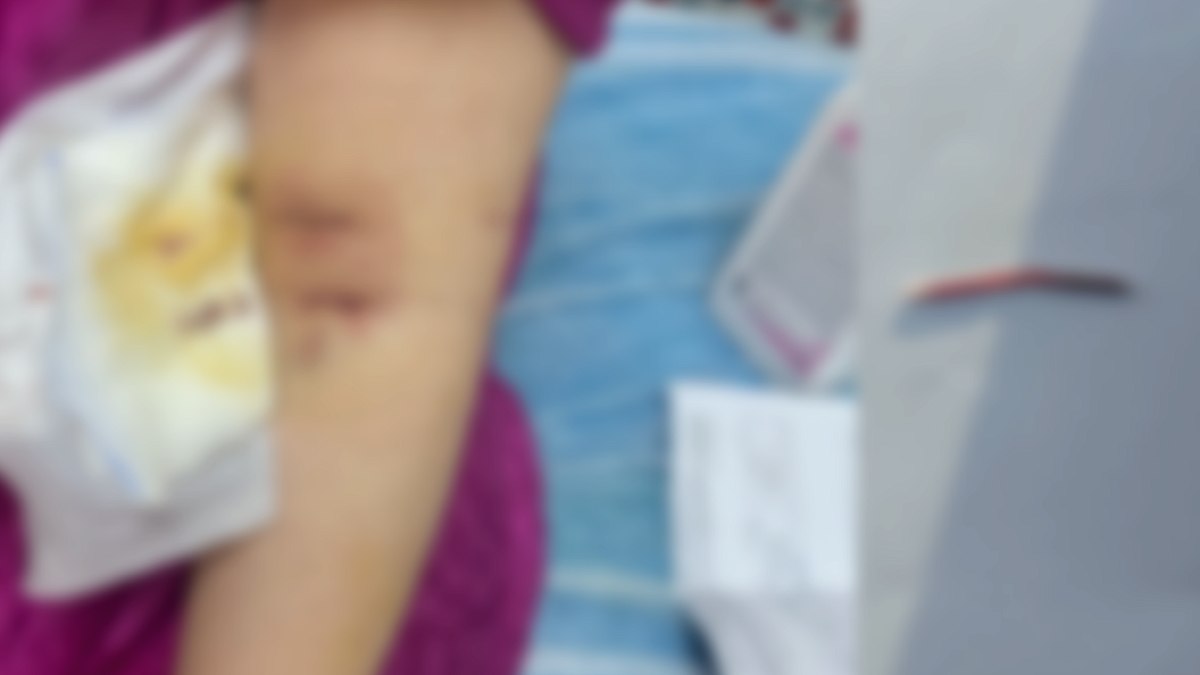 Damar Yolu Açılırken Kolunda Kırılan İğne Ameliyatla Çıkarıldı