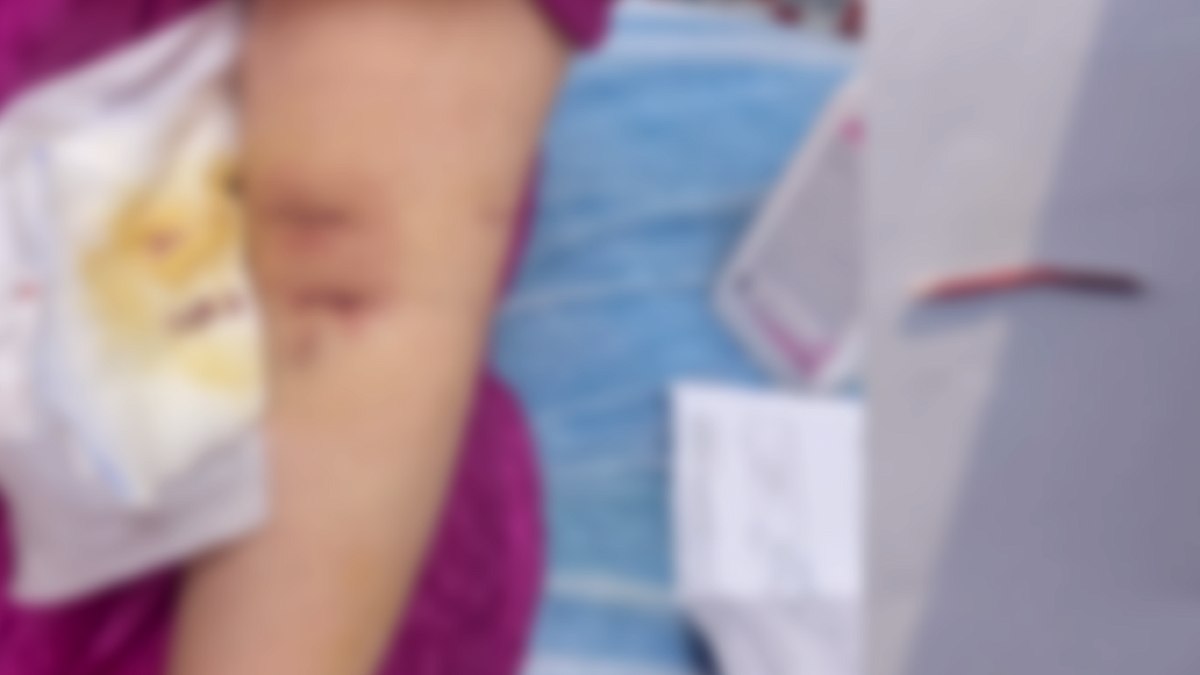 Damar Yolu Açılırken Yaşanan Talihsiz Kaza: İğne Kolunda Kaldı, Genç Kadın Ameliyat Oldu