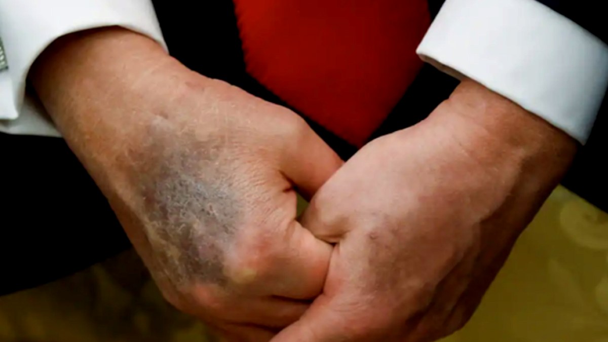 Trump'ın Sağlık Durumu Endişe Veriyor: Doktorlar Kilo Artışına Dikkat Çekti