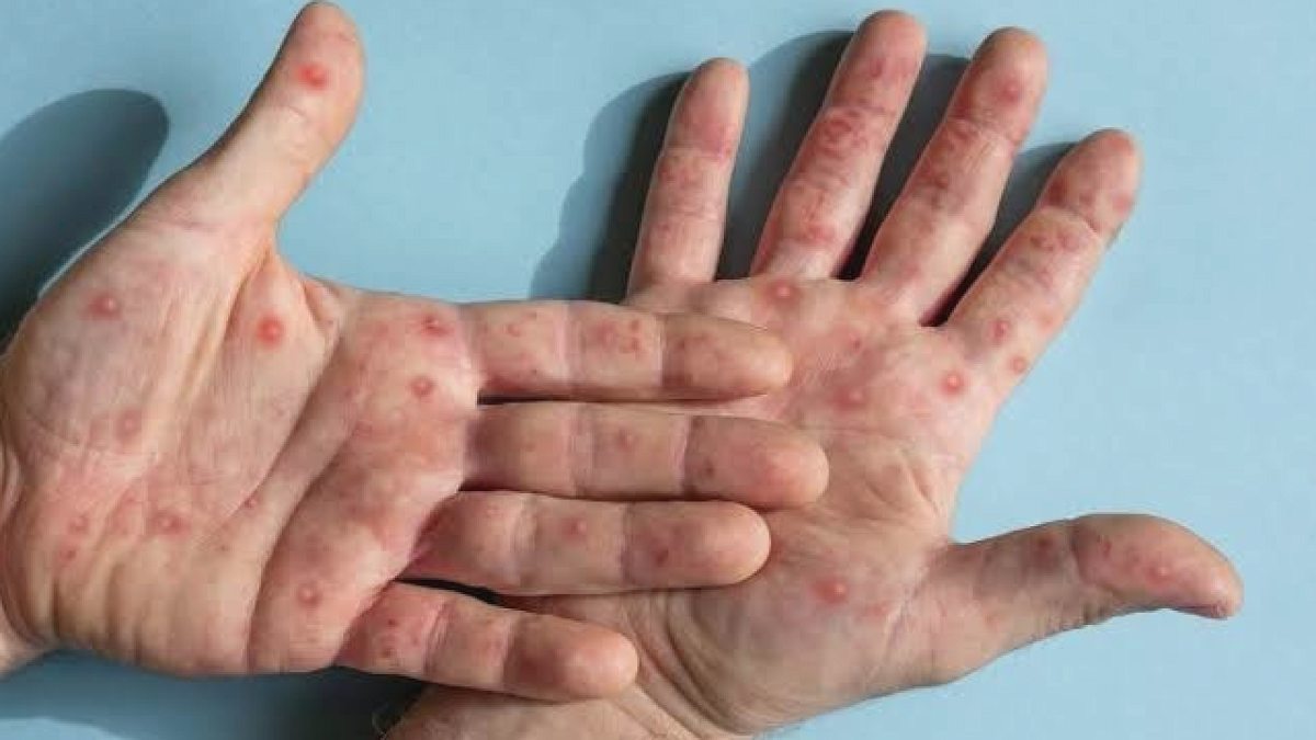 Mpox Virüsü Yeniden Yükselişte: 3 Ülkede Görüldü, Çocuklar Risk Altında