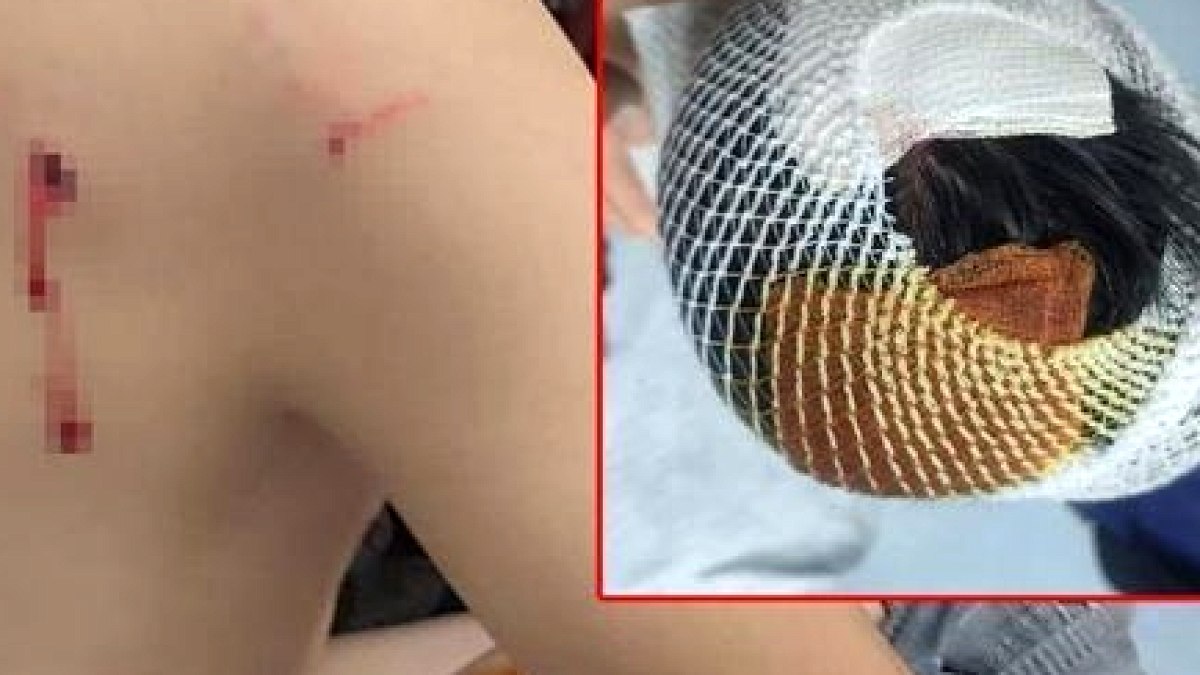 Okuldan Dönen Küçük Çocuğa Sokak Köpekleri Saldırdı: 15 Dikiş